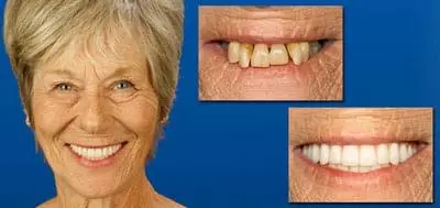 Before and after photo of client who has had dental work done