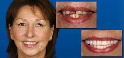 Before and after photo of client who has had dental work done