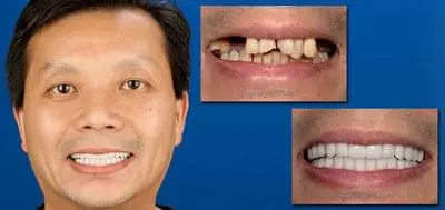Before and after photo of client who has had dental work done