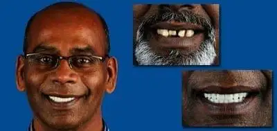 Before and after photo of client who has had dental work done
