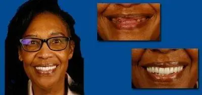 Before and after photo of client who has had dental work done