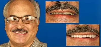 Before and after photo of client who has had dental work done