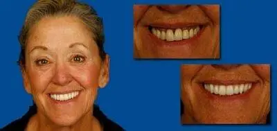 Before and after photo of client who has had dental work done