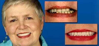 Before and after photo of client who has had dental work done