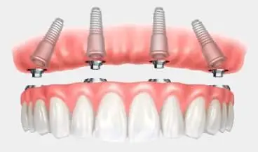 Animated image of designing unique smile