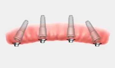 Animated image of extraction implant placing